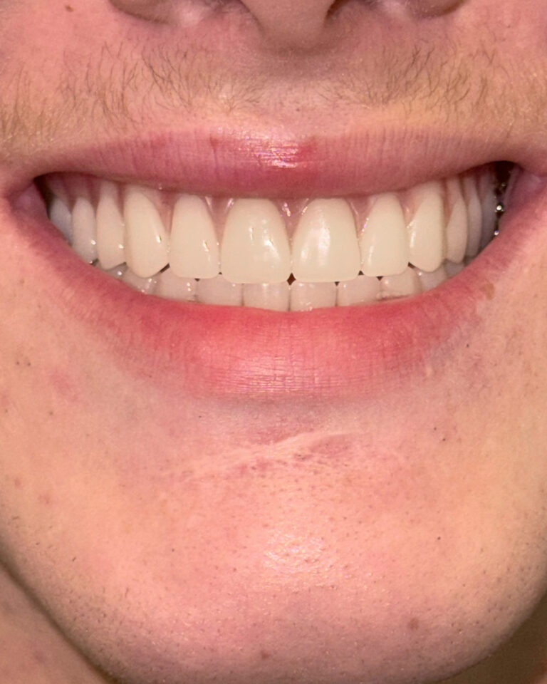 Jack Partridge closeup after digital dentures