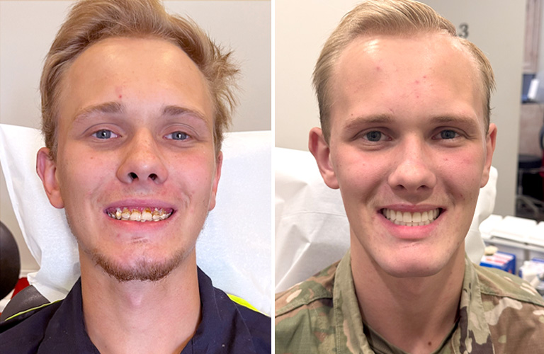 Veteran Jack Partridge before and after photos with his new digital dentures by R-Dent